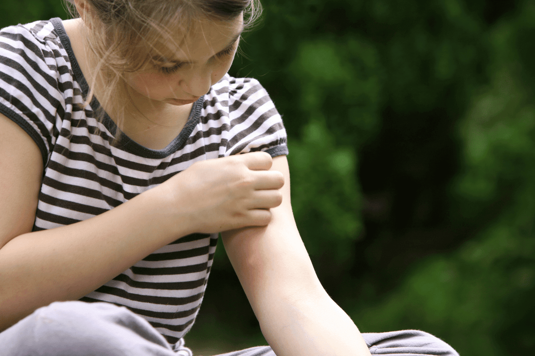 Mosquito Bite Itch Relief: How to Stop Itching